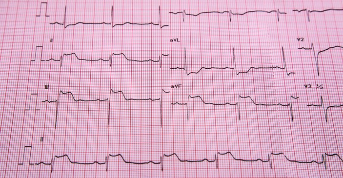 EKG - STEMI - Anzeichen von ST-Hebung und Herzmuskelinfarkt