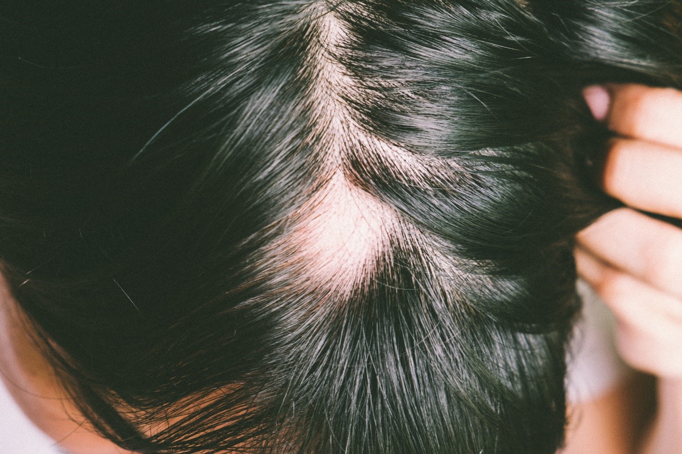 Alopezie, Kopf, schwarzes Haar, Zustand des übermäßigen Haarausfalls