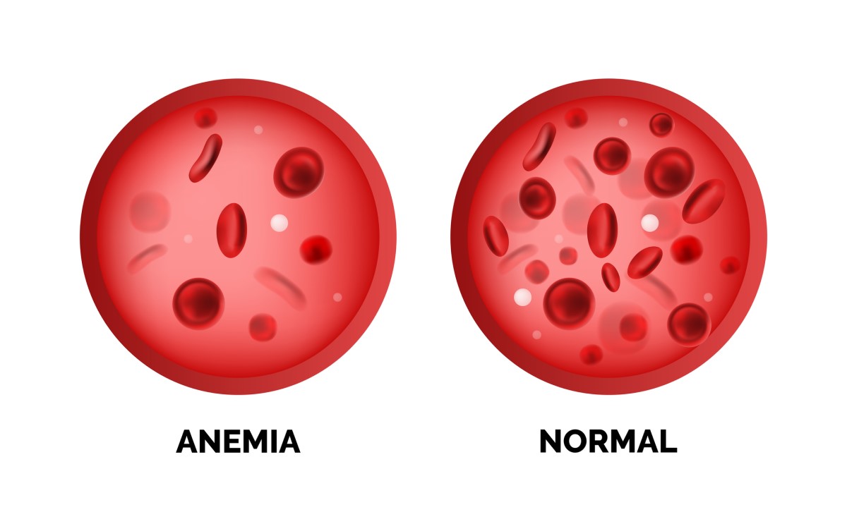 Anämie und normale Erythrozytenwerte im Blut