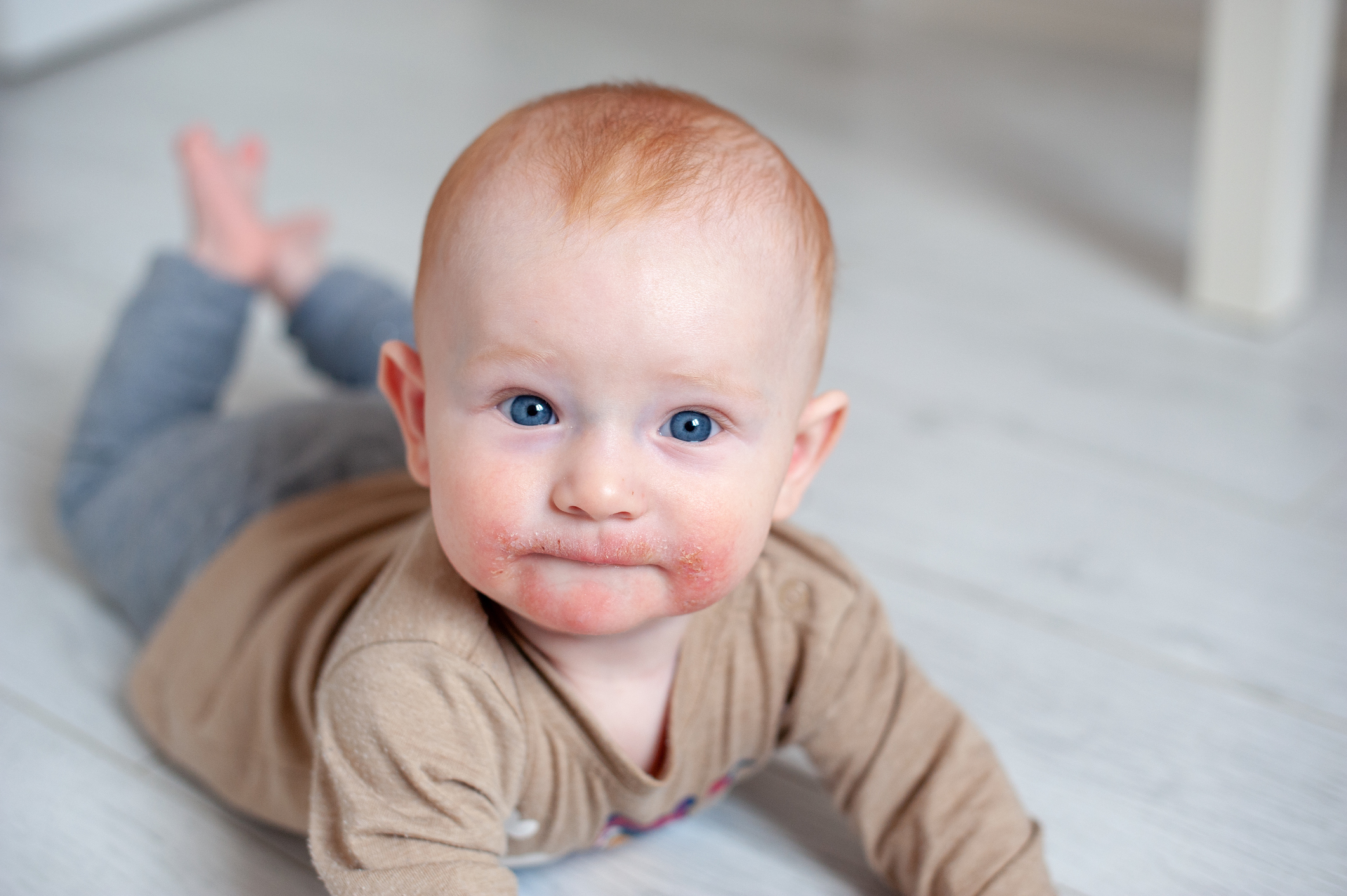 Atopische Dermatitis im Gesicht des Kindes