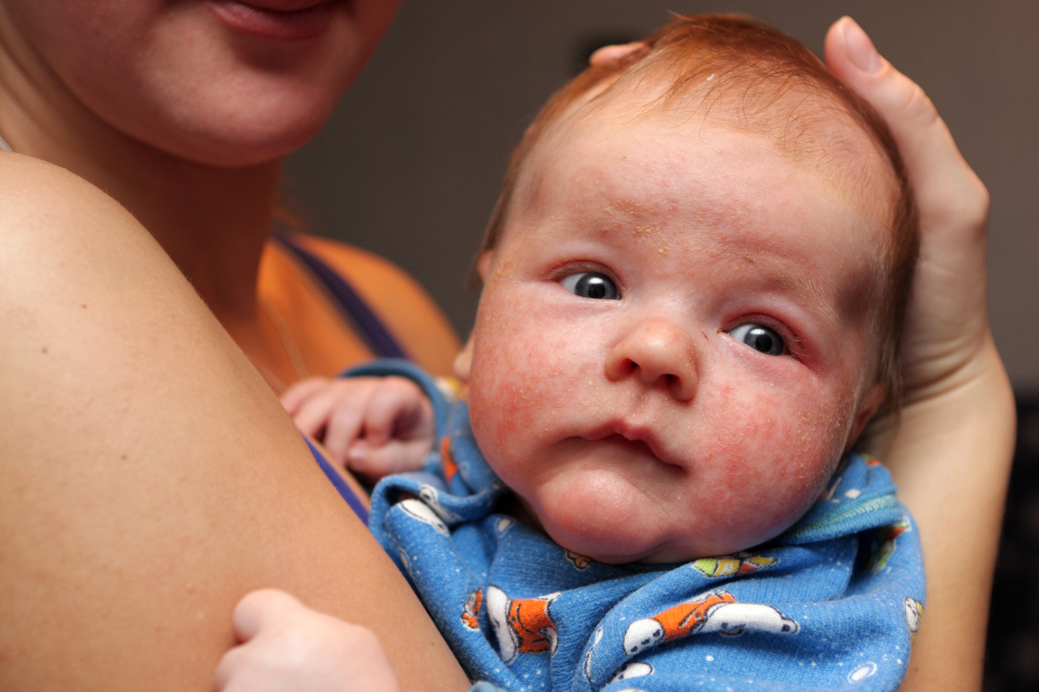 Dermatitis im Gesicht eines Kleinkindes