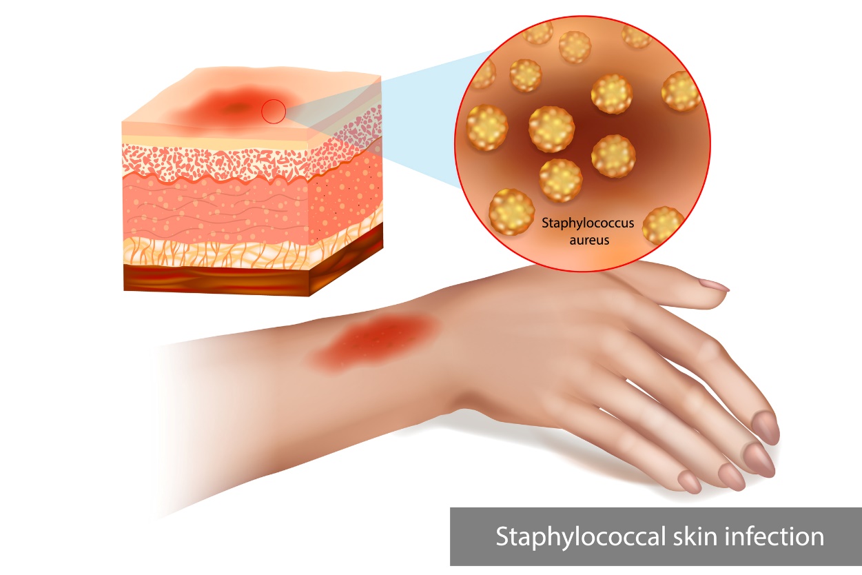 Staphylokokken-Hautinfektion