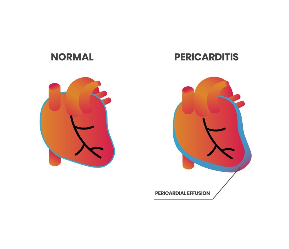 Herzphysiologie und Perikarditis (Herzbeutelerguss)