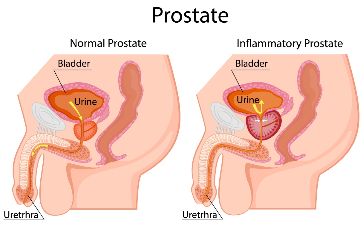 Links: physiologische Prostata. Rechts: vergrößerte Prostata. Liegt unterhalb der Blase. Blase, Urin, Harnröhre.