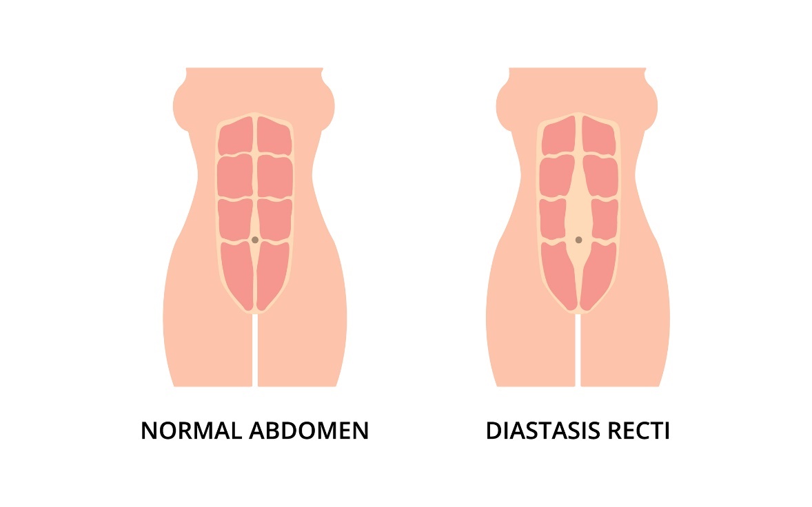 Physiologischer Zustand der Bauchmuskeln und Diastase (Abstand) des linken und rechten Rectus abdominis-Muskels von der Mittellinie der Linea alba