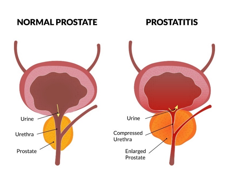 Der physiologische Zustand der Prostata und die Prostatitis