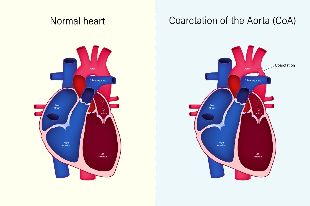 Physiologischer Zustand des Herzens und Aortenisthmusstenose (Coarctation of the Aorta, CoA)