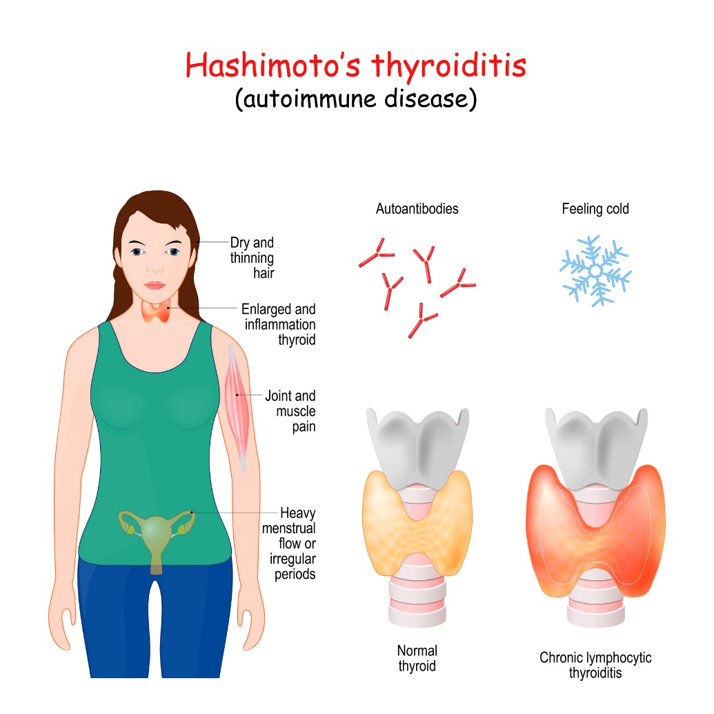 Hashimoto-Thyreoiditis und klinische Symptome