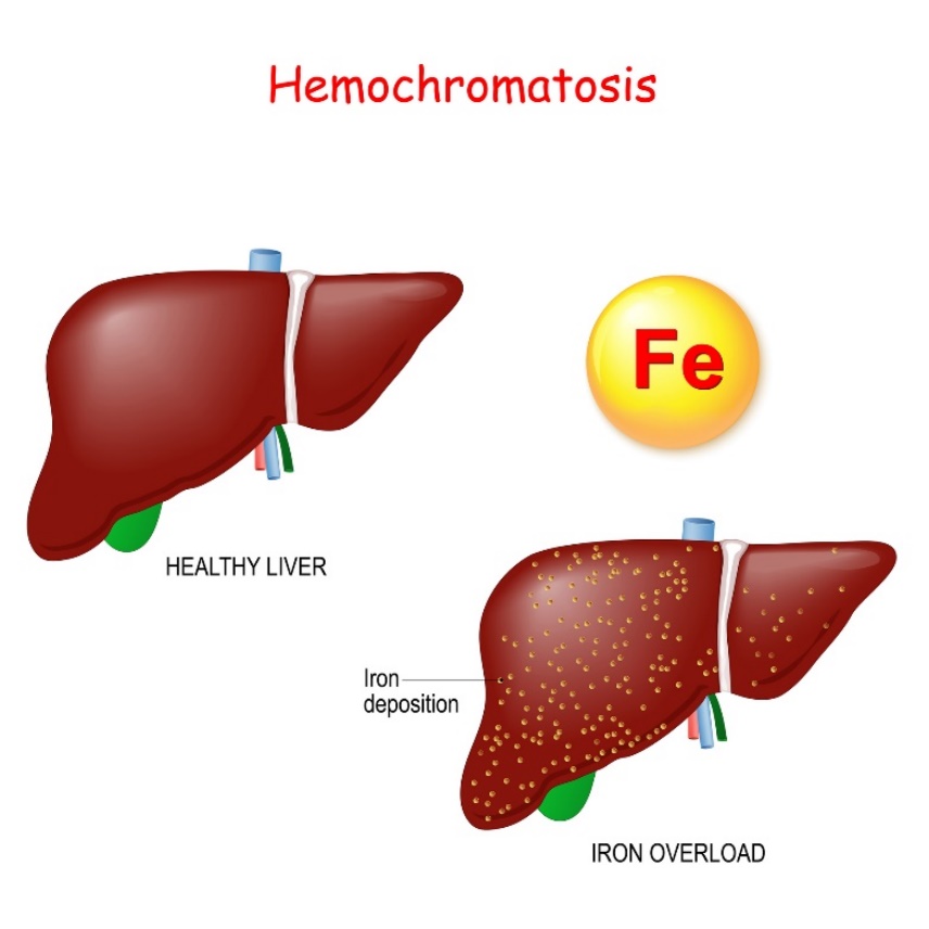 Hämochromatose: Physiologie und Pathologie der Leber mit übermäßiger Ablagerung von Eisen (Fe)