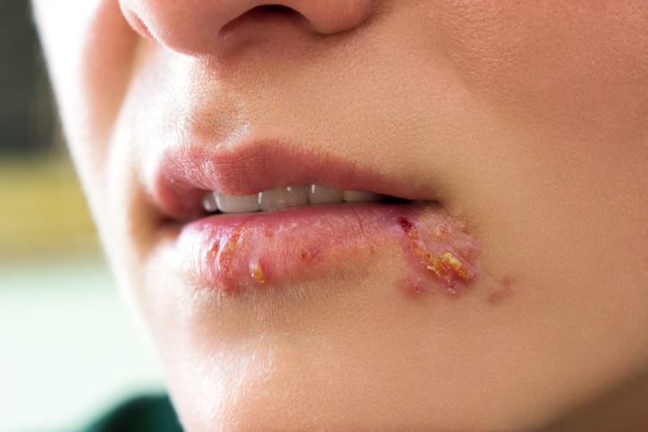 Herpes simplex im Gesicht - Lippen und Mundwinkel