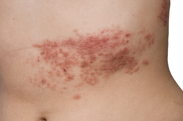 Herpes zoster am Bauch