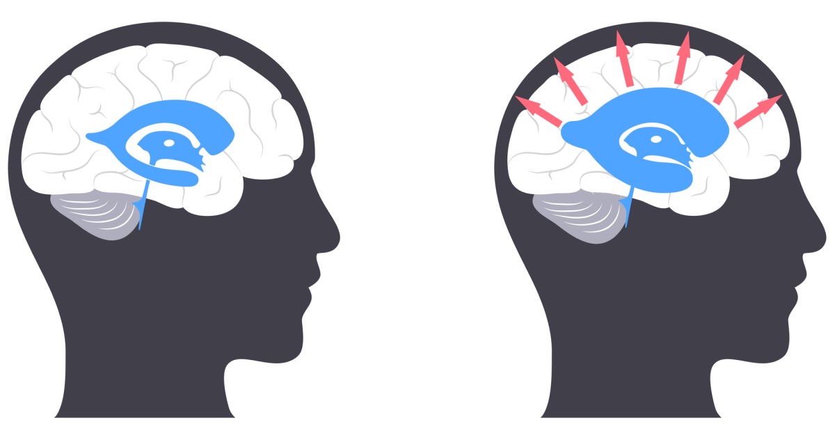 Kopf mit Gehirn - links - normales Gehirn / rechts - Kopf mit Gehirn mit Hydrocephalus, wobei die Pfeile von der Mitte nach außen die Vergrößerung der Hirnventrikel und den Druck auf das Hirngewebe anzeigen.