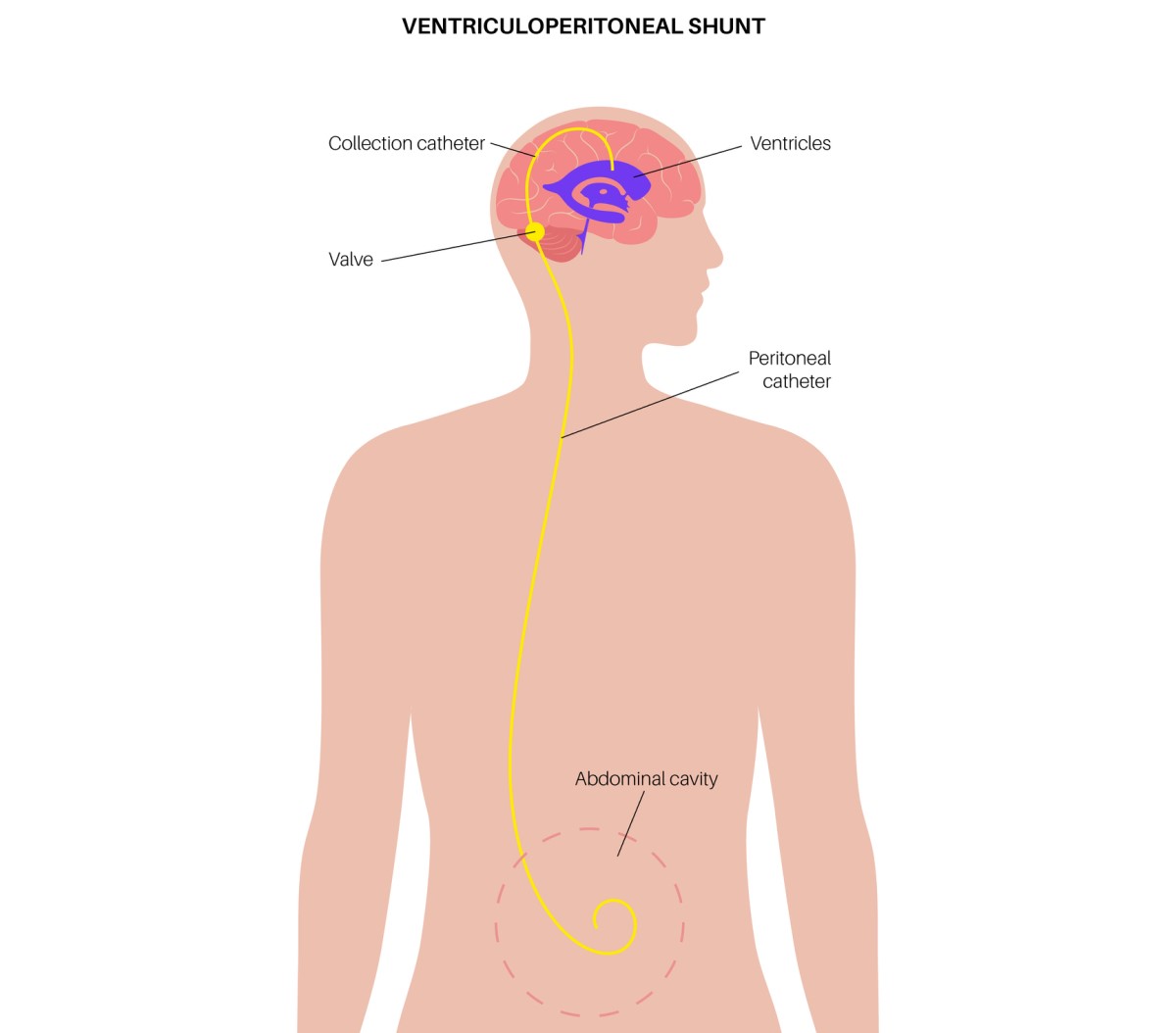 Illustration eines ventrikulo-abdominalen Shunts, der überschüssige Flüssigkeit aus dem Gehirn in die Bauchhöhle ableitet.