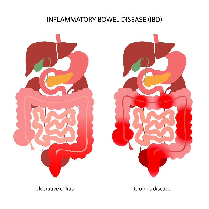 IBD: Unterteilung in Colitis ulcerosa und Morbus Crohn entsprechend der Lokalisierung der Entzündungsreaktion.