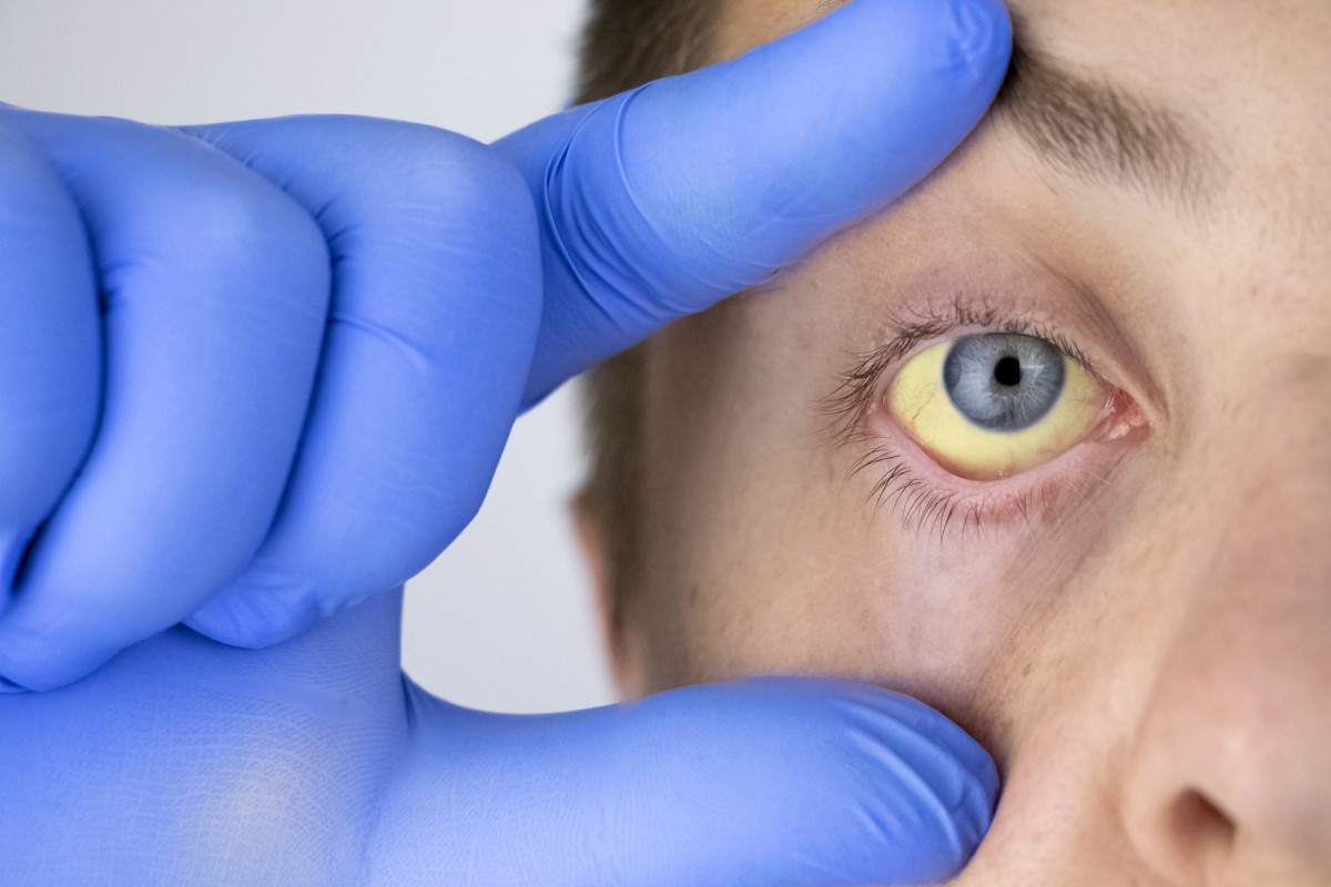 Ikterus, Gelbsucht - Gelbfärbung der Augen als Zeichen einer gestörten Leberfunktion.