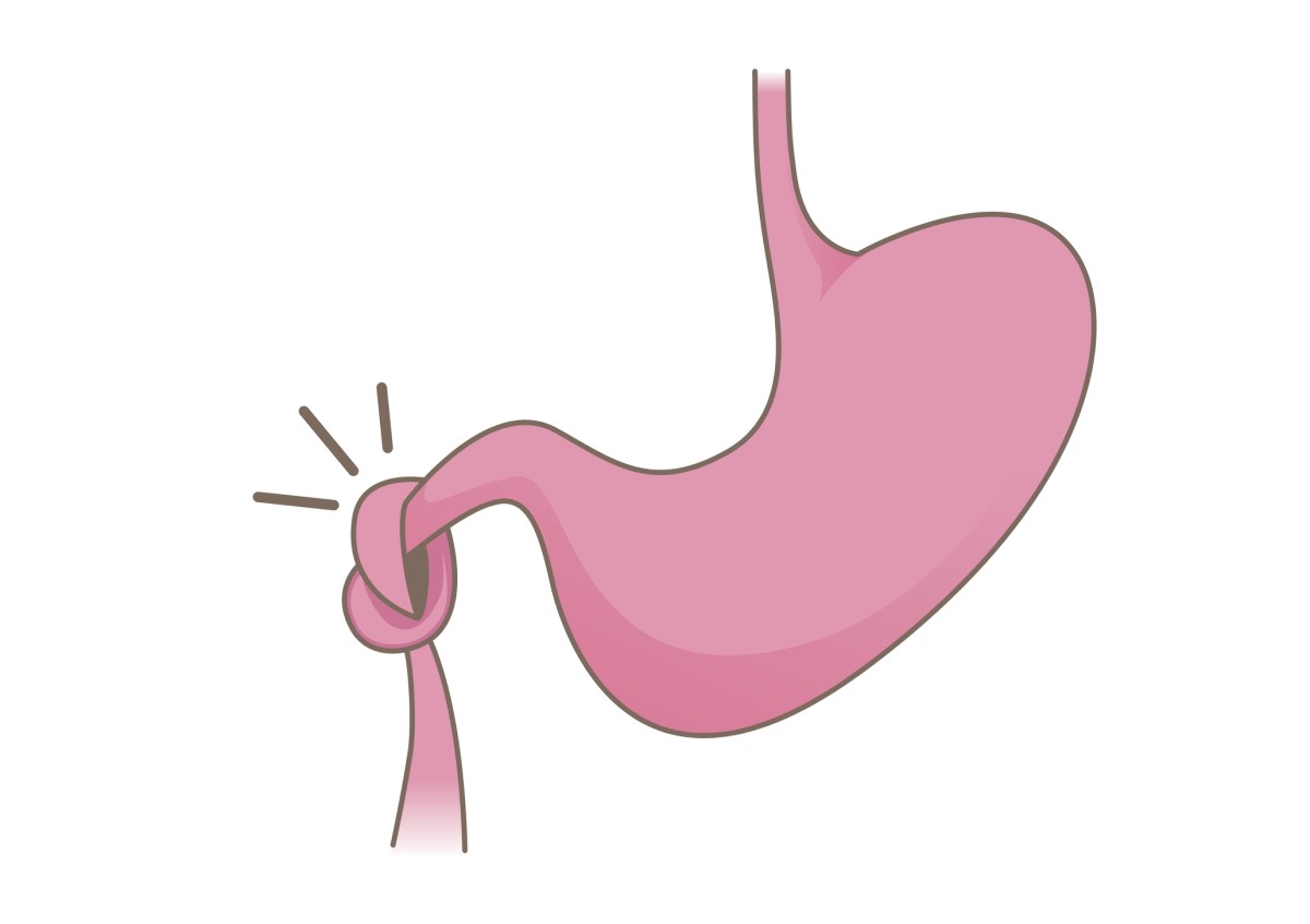 Animation des eingeklemmten Darms und des Darmverschlusses - Ileus des Dünndarms und Magen über dem Darm.