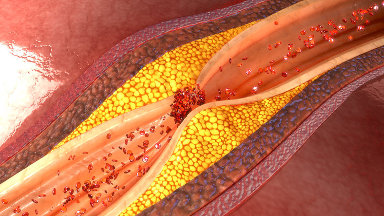 Angina pectoris und Atherosklerose sowie atherosklerotische Plaque in der Koronararterie