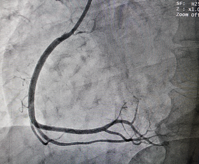 Koronarangiographie - Koronararterie, d.h. das Herz-Kreislauf-System