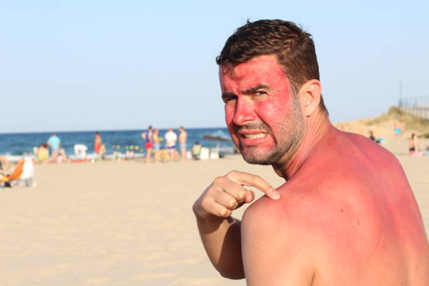 Sonnenbrand ist eine Prädisposition für Hauttumore