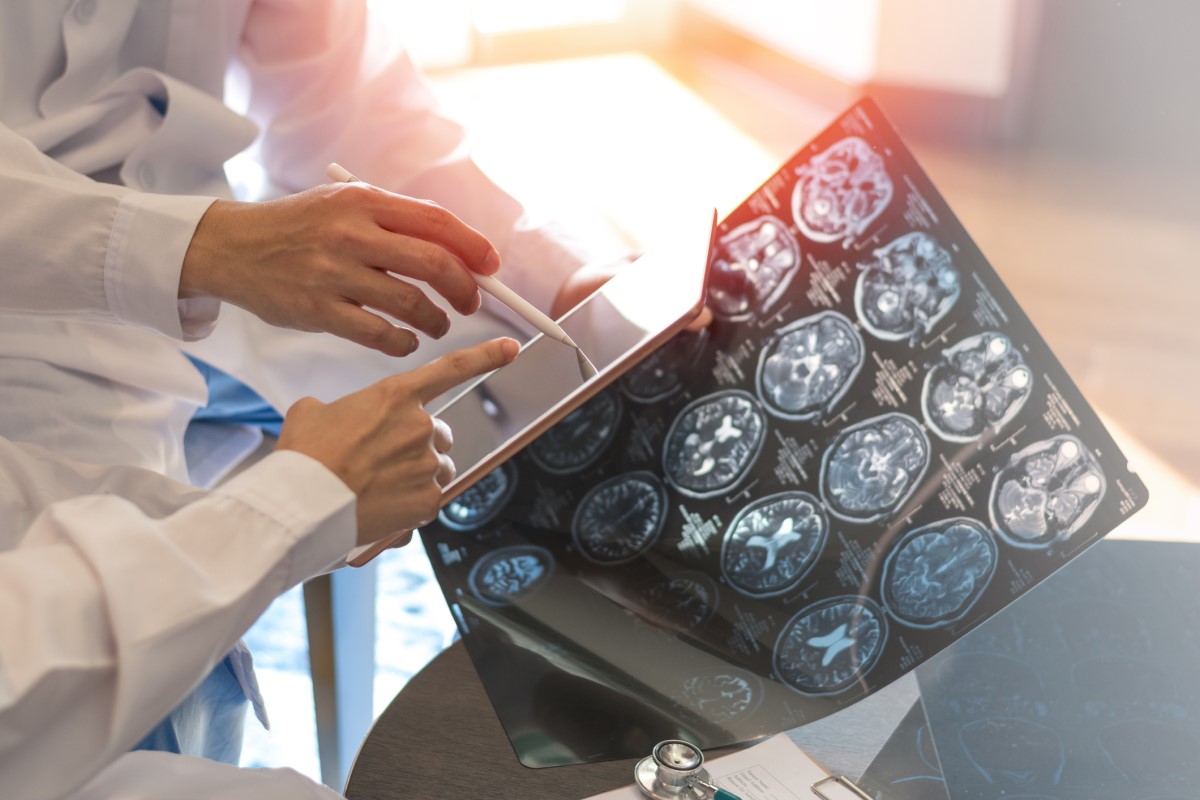 Gehirnscan als Grundlage der Untersuchung, der Arzt hält die Bilder in der einen Hand, in der anderen hält er ein Tablet, beurteilt den Zustand.