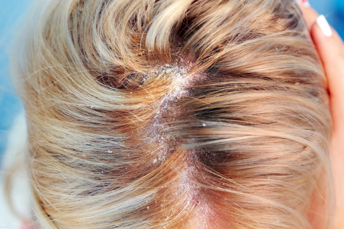 Seborrhoe im Haar einer Frau, Schuppenbildung bei seborrhoischer Dermatitis