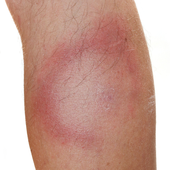 Ein typisches Symptom der Lyme-Borreliose, dh wanderndes Erythem, Hautrötung, mit blassem Zentrum