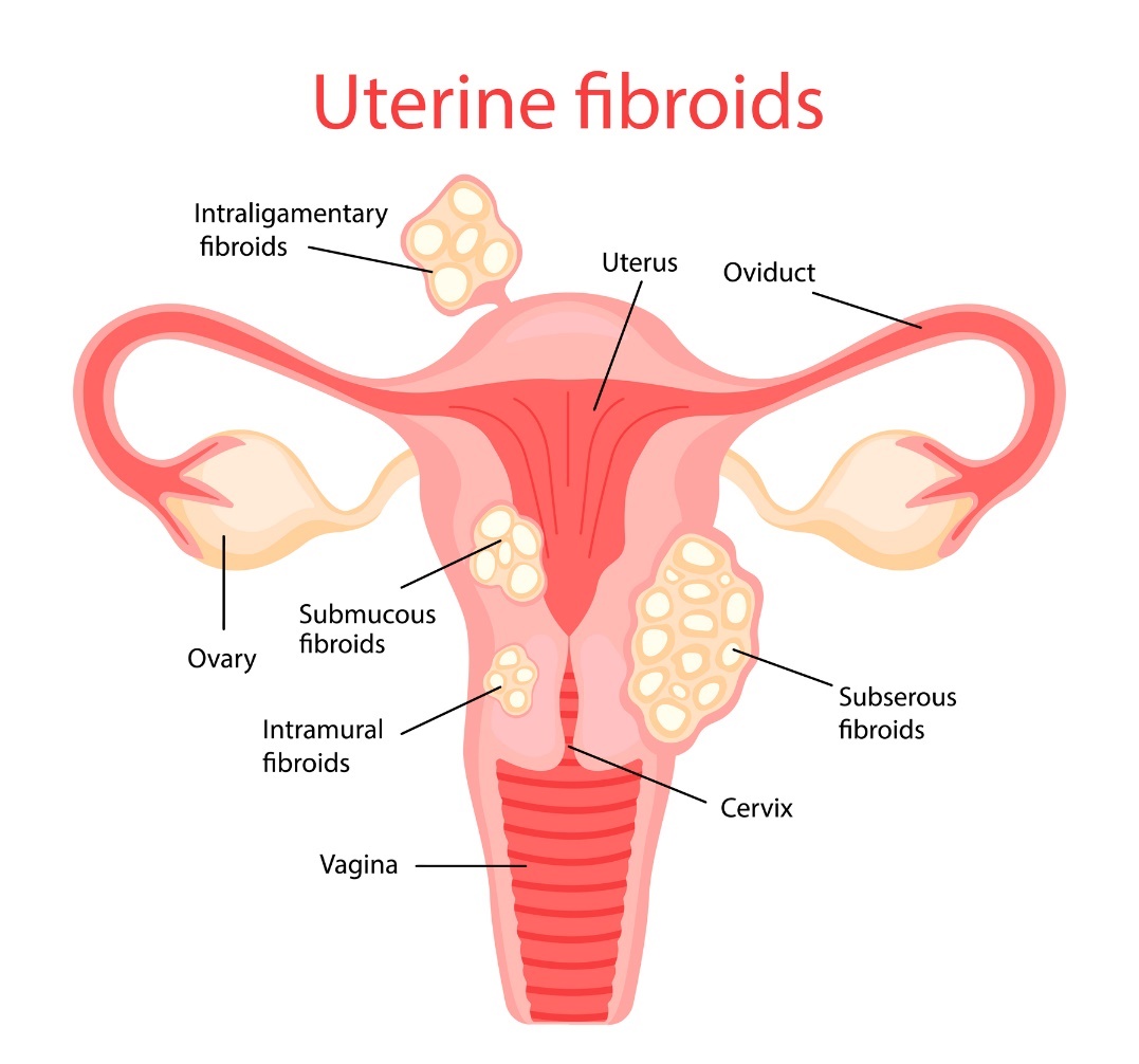 Uterusmyome (Myome der Gebärmutter)