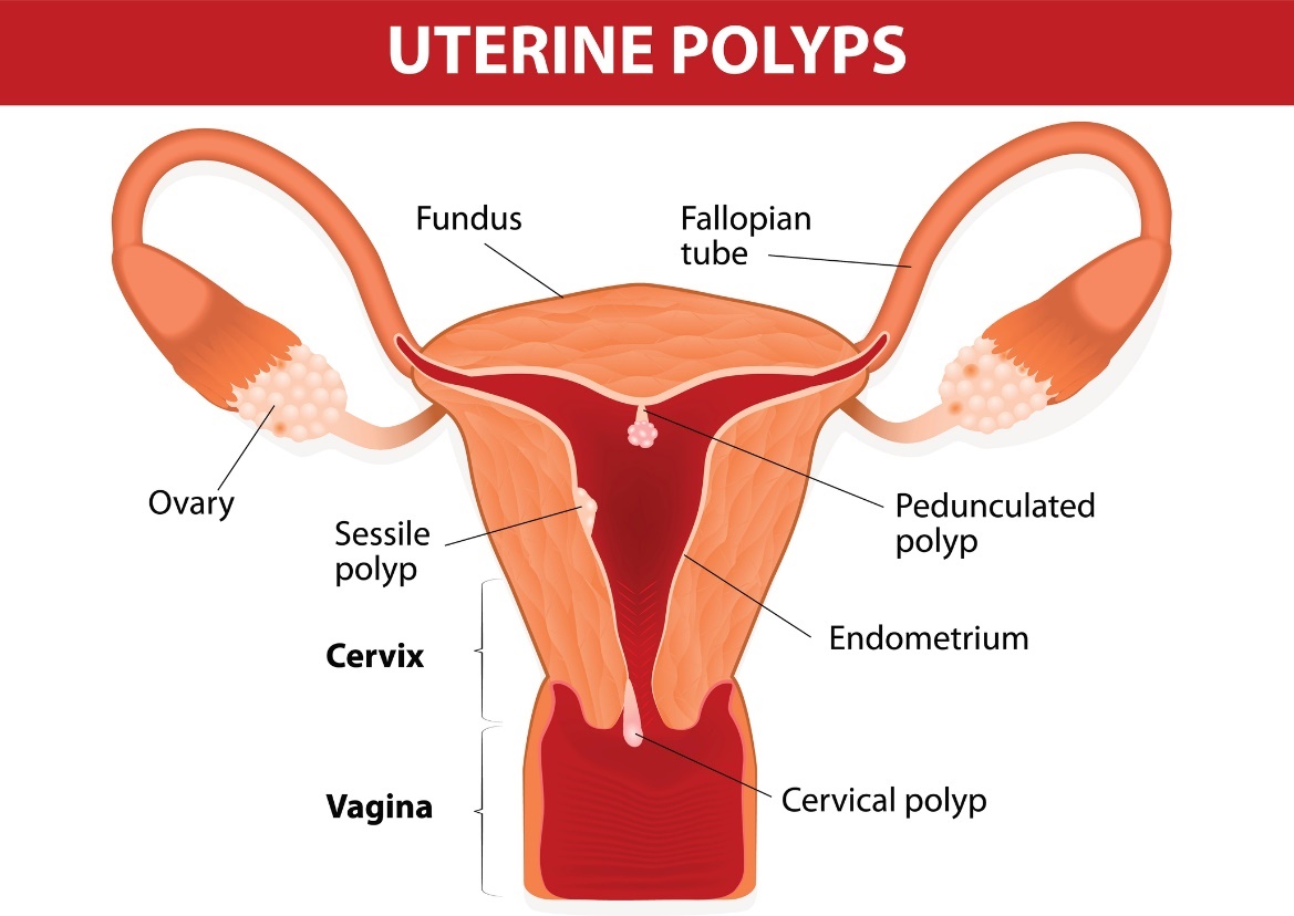 Polypen in der Gebärmutter