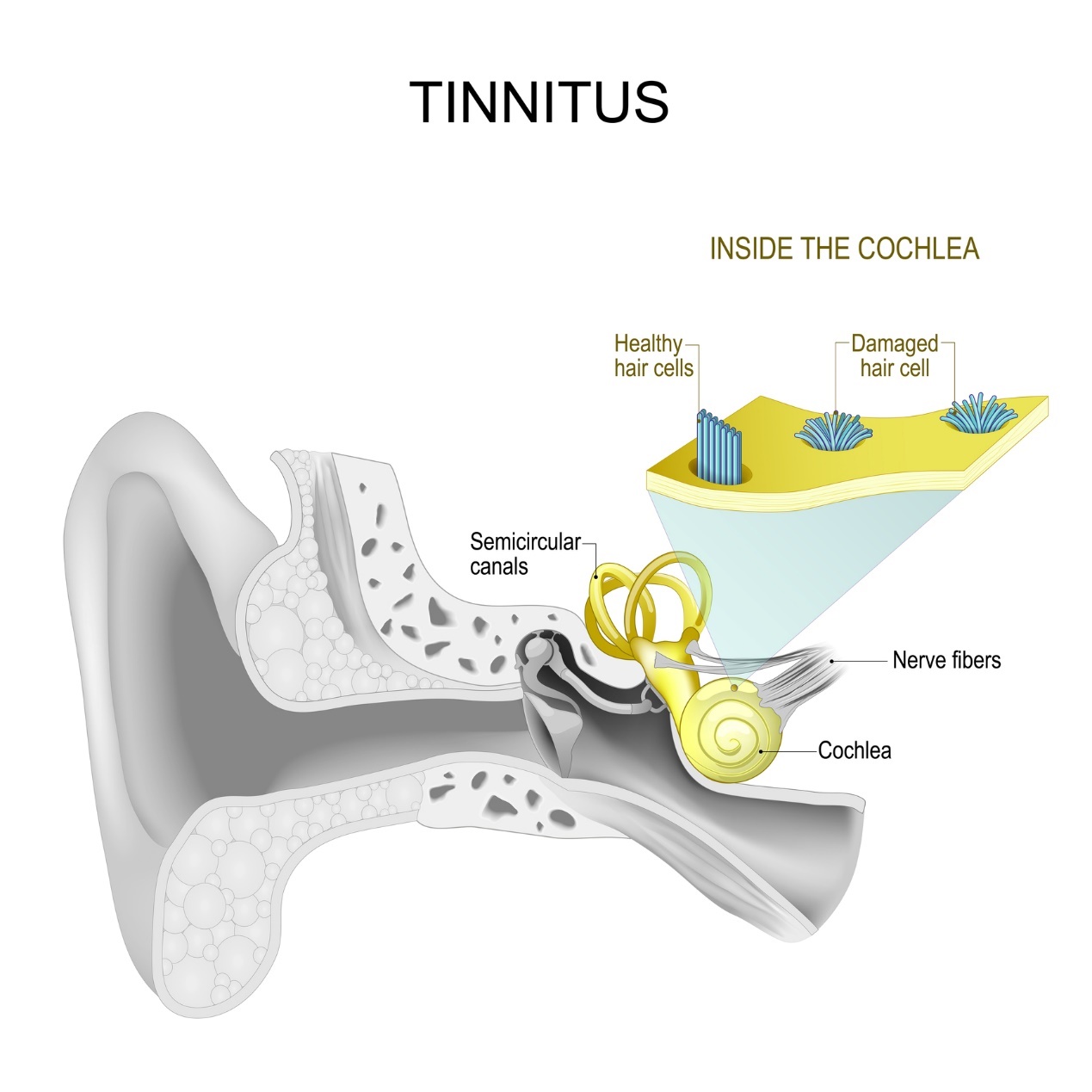 Innenohr und Tinnitus - Pfeifen und Brummen im Ohr