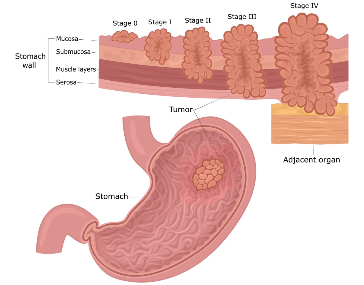 Magenkrebs: die Schichten der Magenwand (Mukosa, Submukosa, Muskel, Serosa) und die Stadien der Tumorentwicklung von der Schleimhaut bis zur Umgebung und den Organen.