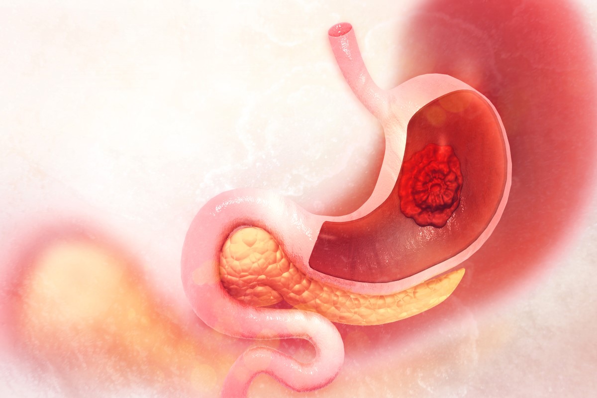 Darstellung eines bösartigen, im Magen lokalisierten Tumors.
