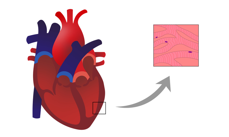 Myokarditis: ein entzündlicher Prozess mit Infiltration und Degeneration der Kardiomyozyten in der Herzmuskelwand.