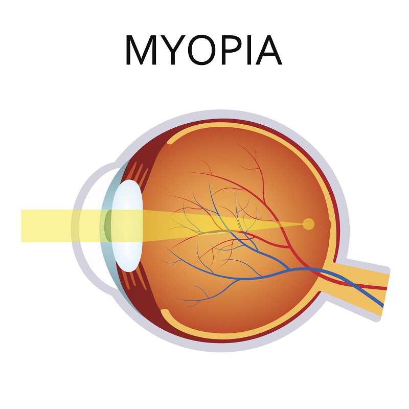Myopie - ein Modell des Auges und der Konvergenz von Lichtstrahlen vor der Netzhaut