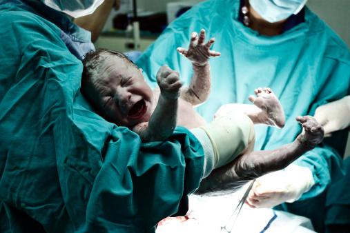 weinendes Neugeborenes in den Händen eines Arztes kurz nach der Sektion