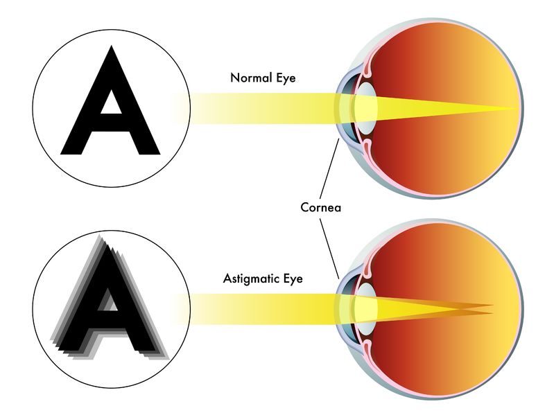 Wie der Buchstabe durch das normale Auge im Vergleich zum astigmatischen Auge gesehen wird