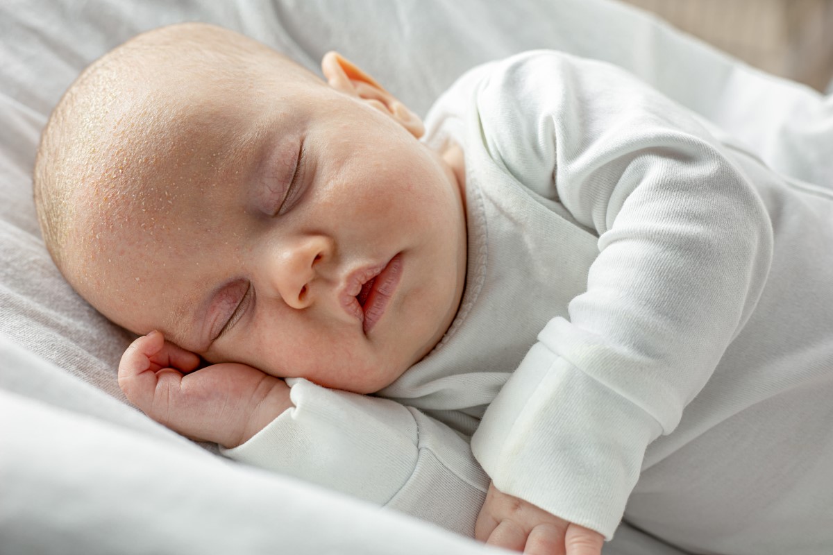 Ein kleines Kind, neugeboren, schlafend, mit Seborrhoe und Schuppen auf dem Kopf.