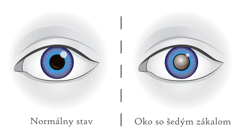 Vergleich: Ein Auge mit Grauem Star und ein gesundes Auge, ein animiertes Bld