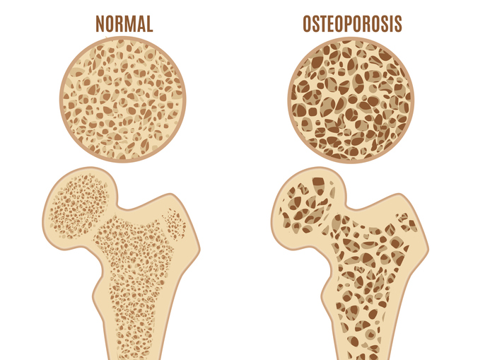 Osteoporose des Oberschenkels