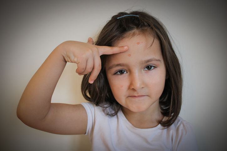 Varicella-Zoster-Virus - ein Mädchen mit einem Hautausschlag im Gesicht