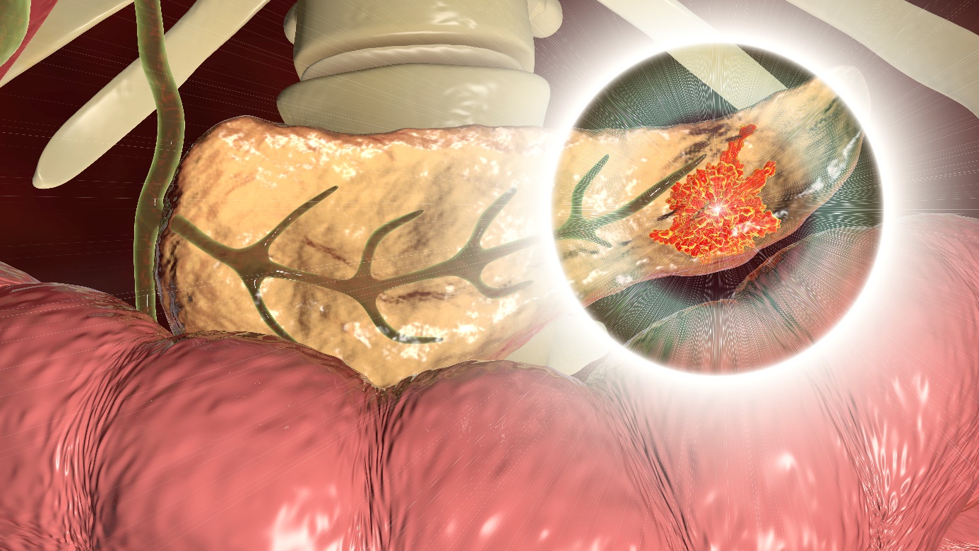 Pankreatitis - infizierter Teil der Bauchspeicheldrüse - Schwanz der Bauchspeicheldrüse, anatomische Darstellung