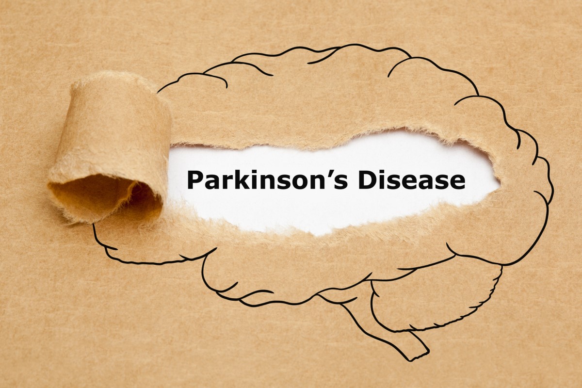 Morbus parkinson = Parkinson-Krankheit = Parkinson-Krankheit - Animation eines Gehirns mit der Parkinson-Krankheit in der Mitte