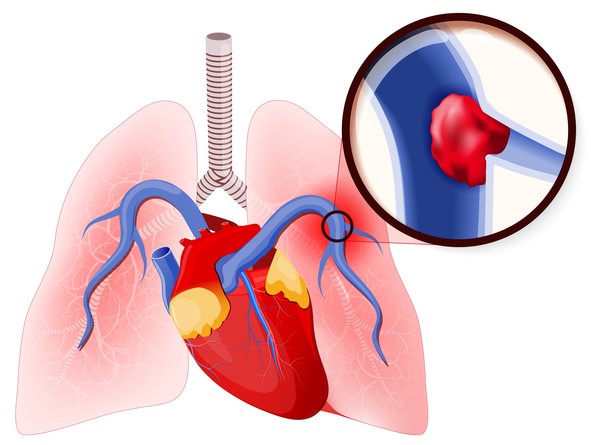 Lungenembolie, Verschluss der Lungenarterie durch ein Blutgerinnsel