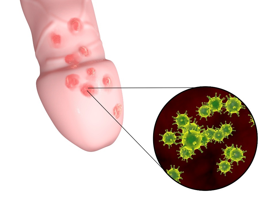 Die Bildung von kleinen Herpesbläschen im Genitalbereich des männlichen Organs.