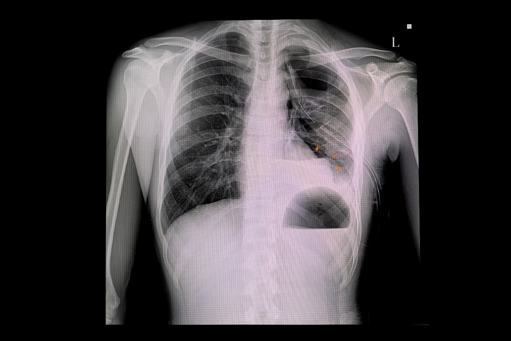 Röntgenbild eines Pneumothorax der linken Lunge und Luftansammlung in der Pleurahöhle des Brustkorbs (weiße Farbe)