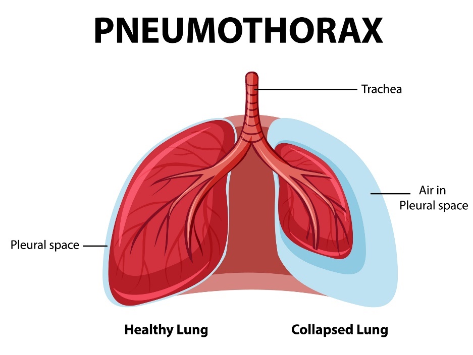 Pneumothorax: gesunde und kollabierende Lungen