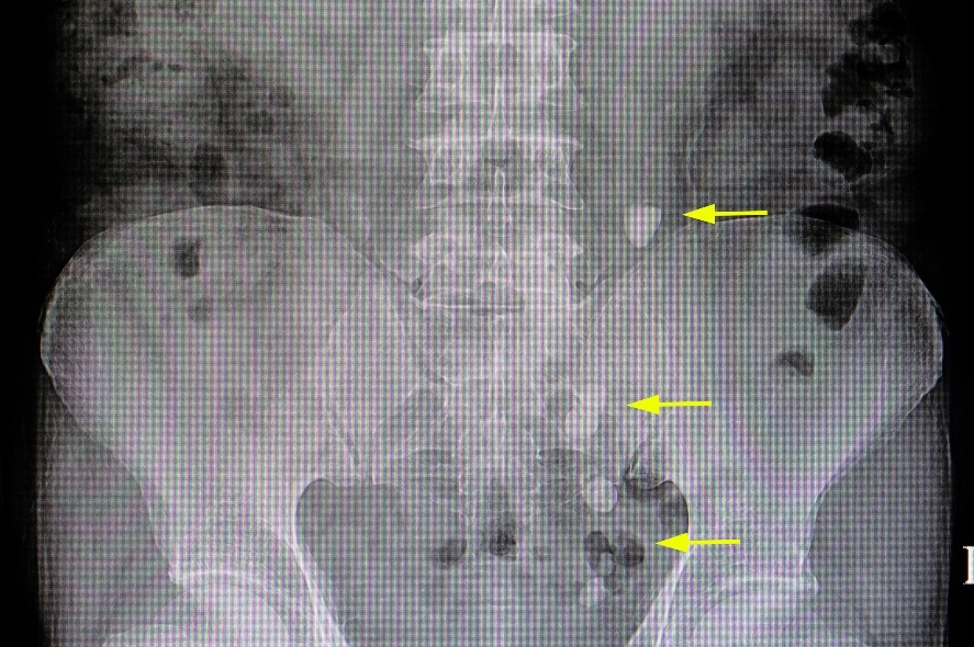 Röntgenbild: zahlreiche Konkremente im Verlauf der ableitenden Harnwege