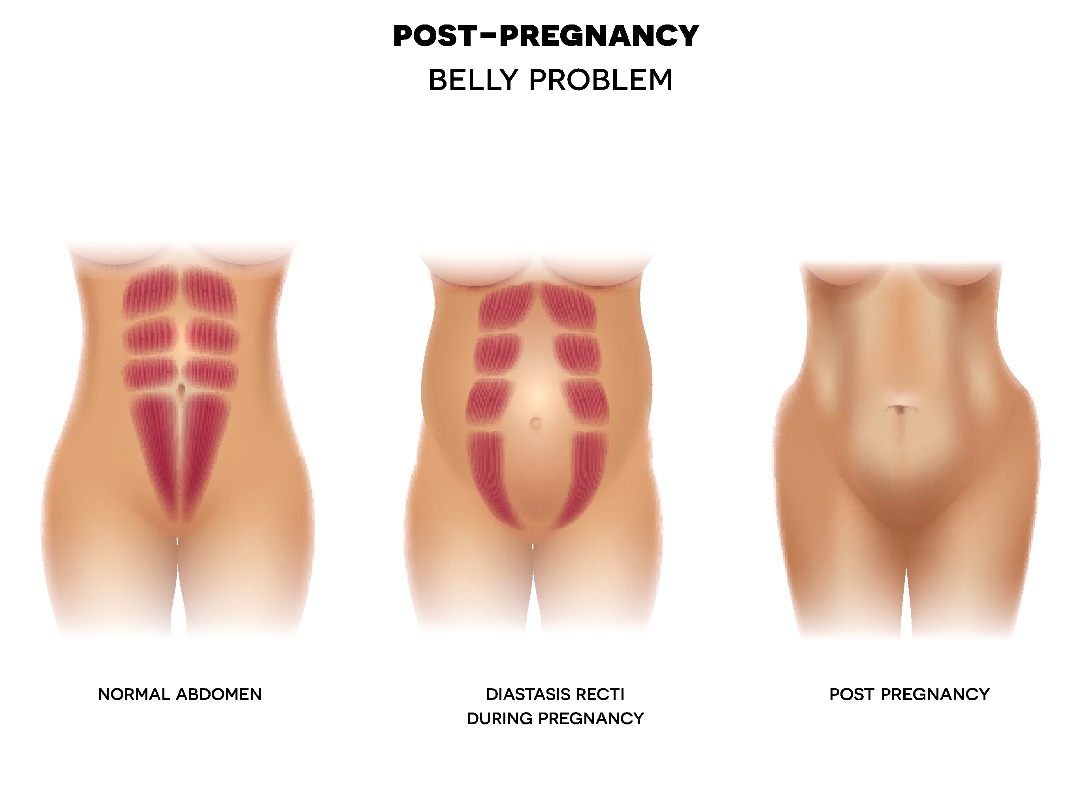 Postpartale Diastase der Bauchdecke