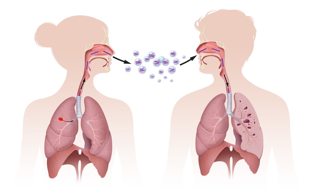 Übertragung von Tuberkulose durch Inhalation, d. h. durch Einatmen, die Abbildung zeigt die Übertragung durch Einatmen.