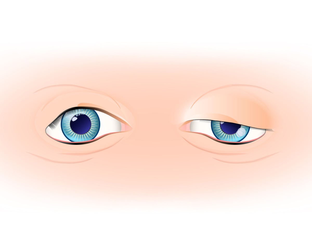 Augenlid-Ptose, linkes Augenlid in normalem Zustand und rechtes Augenlid mit Schlupf - Ptose