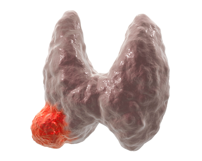 Schilddrüsenkrebs - anatomisches Bild
